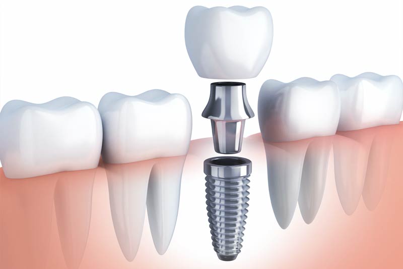 Dental Implants in Woodland