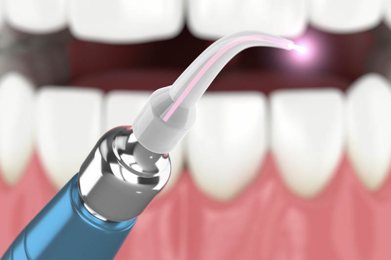 Laser Dentistry in Woodland